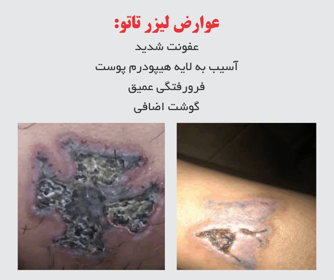 عوارض جبران ناپذیر لیزر