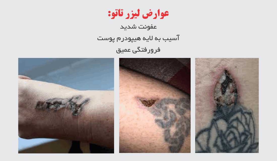 عوارض لیزر تاتو
